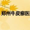 鄭州牛皮癬醫(yī)院哪個較好（鄭州牛皮癬醫(yī)院）