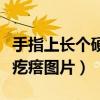 手指上長(zhǎng)個(gè)硬疙瘩腫疼咋回事（手指上起個(gè)硬疙瘩圖片）