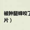 被腫腿蜂咬了抹什么藥（腫腿蜂咬人后癥狀圖片）