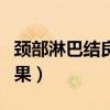 頸部淋巴結(jié)良性的表現(xiàn)（老用手摸淋巴結(jié)的后果）