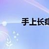 手上長痣會不會癌變（手上長痣）